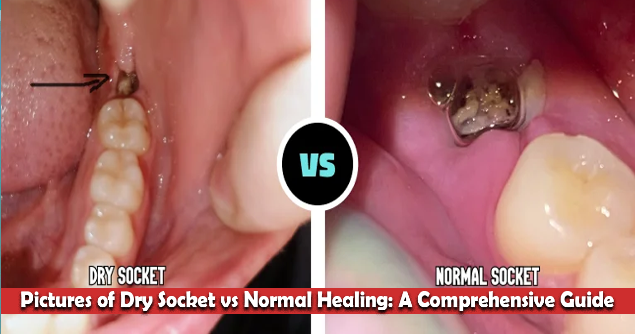 Dry Socket vs Normal Healing