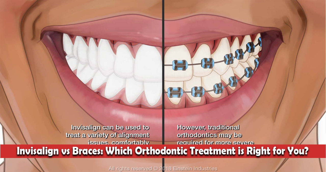 Invisalign vs Braces