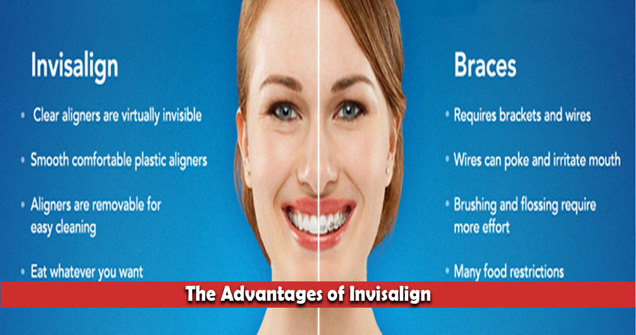 The Advantages of Invisalign