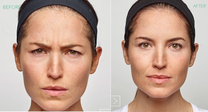 The Ultimate Guide to Xeomin vs Botox: Choosing Your Perfect Wrinkle Relaxer Xeomin vs Botox