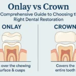 Onlay vs Crown